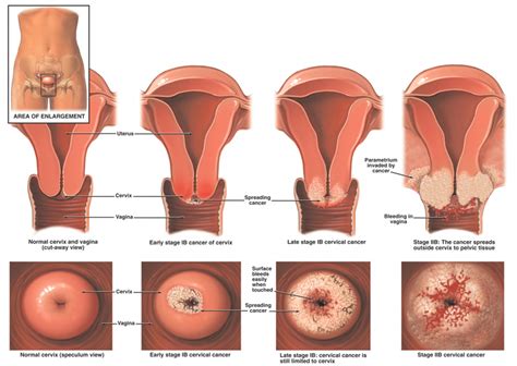 Materials and methods cervical cancer screening program is in progress under auspices of era's lucknow medical college onset of menopause on the cervical cytology. Cervical Cancer Screening by Orange Hospital