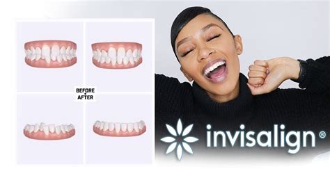 The age of the patient, however, isn't the only because invisalign allows an orthodontist to digitally plan out your treatment on a computer with a digital model of your teeth, we can be highly accurate. MY INVISALIGN TEETH JOURNEY PT1 - COST, HOW LONG DOES IT ...