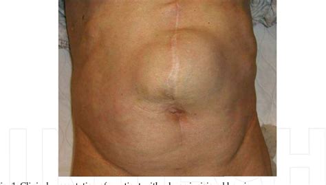 Incisional hernia surgery, a highly successful hernia treatment procedure. Figure 1 from 11 Laparoscopic Incisional Hernia Repair - Semantic Scholar