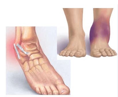 Terdapat sakit dan bengkak di bahagian belakang pergelangan kaki (sakit tumit), di atas kawasan tendon achilles, atau ketidakupayaan untuk. Buku Lali Kulit Keras / Terdapat banyak templat yang boleh ...