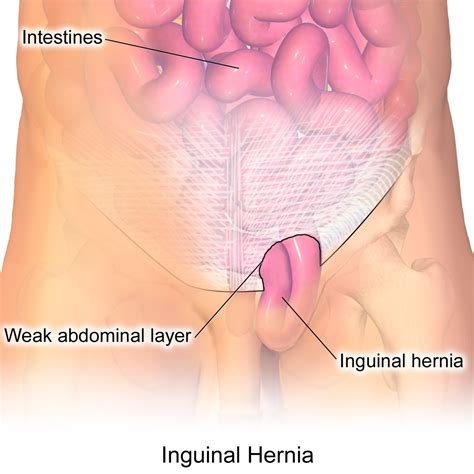 My question is what caused it to randomly start giving me pain, why is my stomach red, and what does all this mean i'm an 20 year old female in very good health. Hernia Surgery : Dr Clement Tsang/Specialist Surgeon