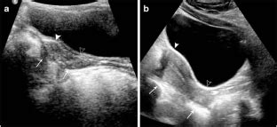 Pelvic ultrasound. radiological society of north america: Emergent ultrasound evaluation of the pediatric female ...