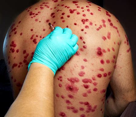 Skin Rash Treatment On Male Body Shingles Disease Herpes Zoster ...
