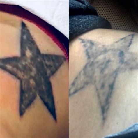 We are removery, north houston's laser tattoo removal people. Laser Tattoo Removal in Houston, TX | Tattoo Removal in ...