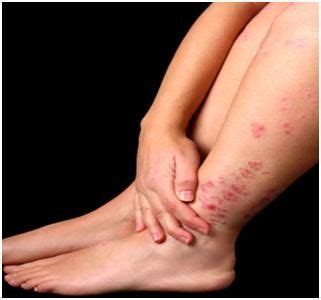 How to get rid of eczema quickly step by step click to see ...