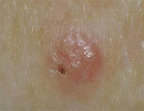 Skin cancer is the most common form of cancer. Medical Pictures Info - Skin Cancer