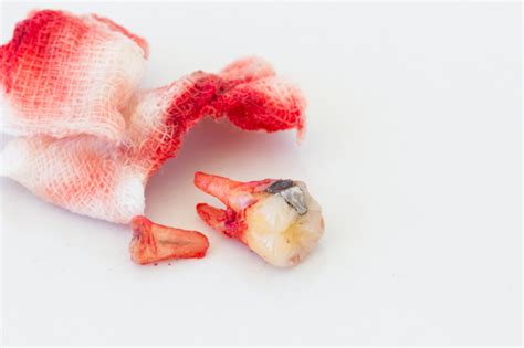 Our body takes 8 minutes to stop any type of but, in the case of tooth extraction, the scenario is different. gauze with blood from tooth - First Aid Reference