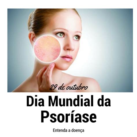 Se você sofre com a psoríase, este assunto é para você. Psoríase: entenda a doença e tratamentos para amenizar ...