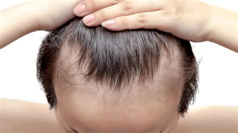 How to spot a changing hairline 7 Signs of an Iodine Deficiency to Never Ignore