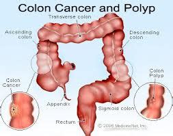 The stage tells whether it has spread and how far. Cancer - Killer Disease: Colon cancer,symptoms, causes and ...