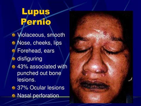 Lupus pernio is a chronic raised indurated (hardened) lesion of the skin, often purplish in color. PPT - Monocyte/Macrophage Disorders PowerPoint ...