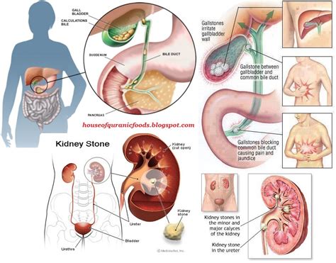 Kebanyakan batu karang hempedu tidak menyebabkan tidak menunjukkan tanda atau gejala. ama zabidi's blog: PENGALAMAN BUAT DETOX LIVER