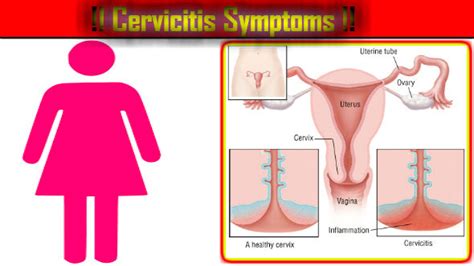 Large intestine colon cancer 10 causes in urdu badi aant ke sartan ki waja iska ilaj kase kyea jata. Cervicitis Symptoms: Garbhashay Griva ke Lakshan aur Karan