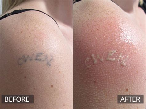Costs less than one laser treatment. Laser Tattoo Removal Melbourne | The DOC Clinic Hoppers ...