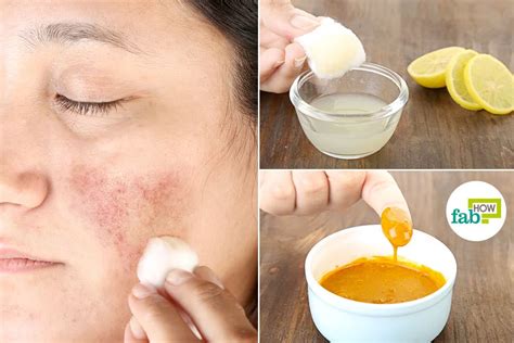 More oil will accumulate on your face which means that you are going to develop blackheads, whiteheads, pimples, and other skin issues more often as compared to. How to Get Rid of Hyperpigmentation: Top 10 Remedies to ...