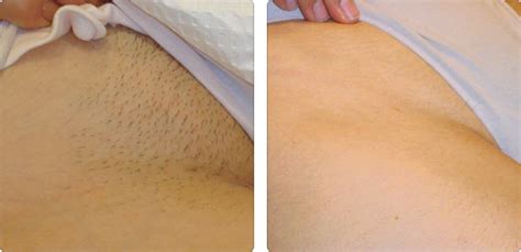 Skn clinics are rated 4.9 out of 5 for laser hair removal based on 5514 reviews across all our clinics. Laser Hair Removal - Hayes Valley Medical & Esthetics