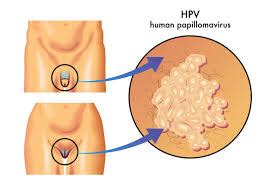 O hpv é a sigla de papiloma vírus humano. LPPKN - Jumlah Wanita Mendapatkan Suntikan HPV Meningkat ...