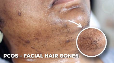 If you're bothered by the hair that grows on your face, follow these eight tips for smooth hairless skin. HOW TO WAX YOUR CHIN HAIR AT HOME | DIY Sugar Wax Hair ...