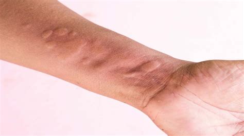 Jun 09, 2020 · hives (urticaria) are red, itchy welts that result from a skin reaction. Doctors Explain What Happens to Your Body if You Develop Hives