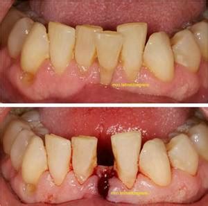 Feb 17, 2021 · dry socket, or alveolar osteitis, is a common complication of tooth extraction. Dry socket Causes, Symptoms, Diagnosis and treatment ...