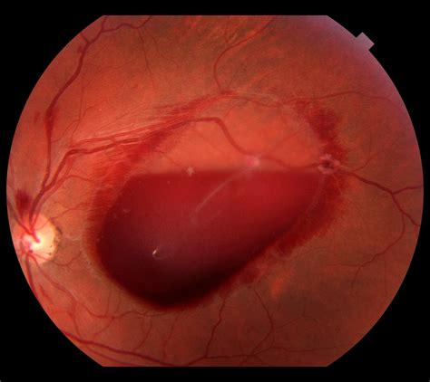 A subhyaloid hemorrhage attributed to valsalva. Lift with your legs, kids! : Ophthalmology