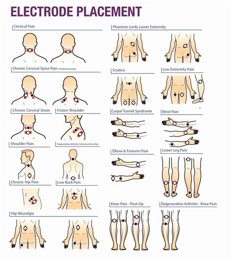 Tens unit pad placement for tennis elbow. Electrode Pad Placement Chart Elegant Tens Unit Pads ...