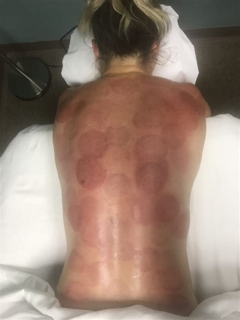 As a chiropractor, we provide patients in san. How Does Cupping Therapy Really Feel And How Does It Aid ...