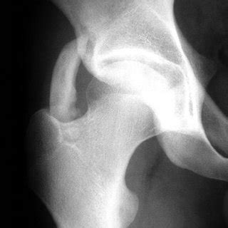 (PDF) Heterotopic ossification following surgical ...