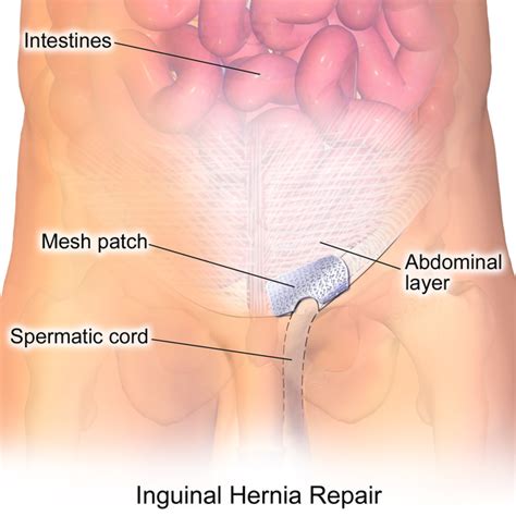 We did not find results for: Consent: Hernia Repair (Open or Laparoscopic) - TeachMeSurgery