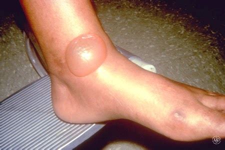 Diabetic feet (picture 2) are the result of uncontrolled high level of blood sugar and can become a rather dangerous complication of the disease. What Does Diabetes Look Like On Legs - DiabetesWalls