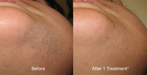 Your hair loss generally can't be prevented or controlled, but it can be managed. Laser Hair Removal Orlando, FL