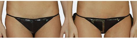 Do what feels comfortable for you! Bikini Line Laser Hair Removal | Courthouse Clinics