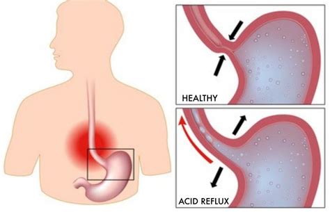 This layer basically acts as a barrier which helps prevent any acid reflux from coming up your esophagus and getting into your throat. How To Get Rid Of Acid Reflux Naturally - Fitneass