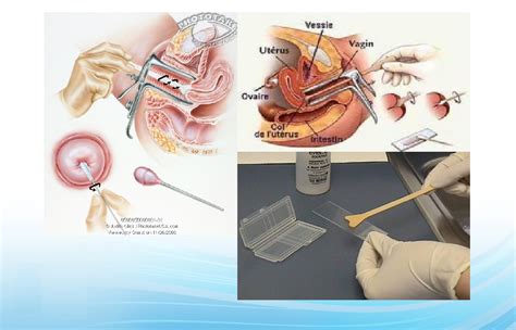 Selain itu, dokter juga dapat menganjurkan agar pemeriksaan dilakukan lebih sering jika pasien memiliki faktor risiko tertentu. MyLittleYaya: Sudahkah Anda Semua Melakukan Ujian Pap Smear