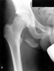 Anteroposterior radiograph of the right hip, showing an ...