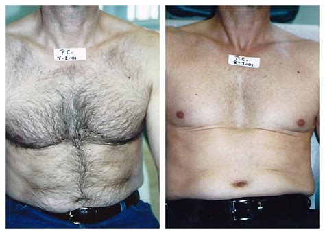 There is a right way to approach the task of hair trimming and removal, and it differs for each body part. Laser Hair Removal for Men - Happel Laser Center - Pittsburgh