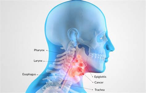 Đây là loại ung thư phát triển chậm và hầu như ở giai đoạn đầu không có dấu hiệu tiêu biểu gì. Ung Thư Hạ Họng: Nguyên Nhân, Triệu Chứng Và Cách Điều Trị