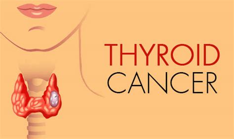 Some doctors think this is because new technology is allowing them to find small thyroid cancers that may not have been found in the past. Thyroid Cancer - The Wellness Corner