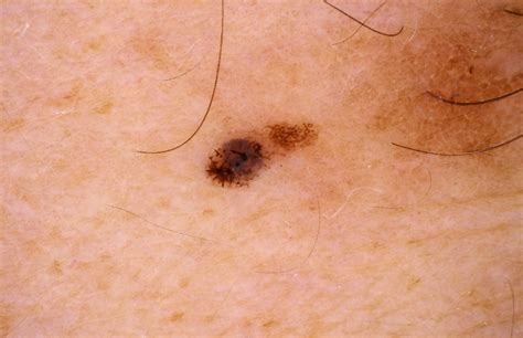 Thanks also for allowing me to take a look at what melanoma looks like up close and personal. Melanoma - ASSC