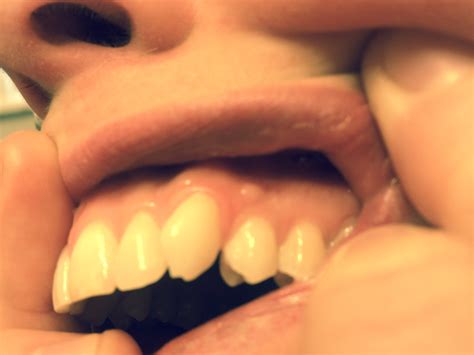 The condition starts off as a lump which is often mistaken for a cyst but is rather most of the times, these pimples start off as very tiny eruptions and then gradually grow in size till they give off the appearance of a bump. Tiny Bumps On Mouth Roof : Red Dots Roof Of Mouth ...