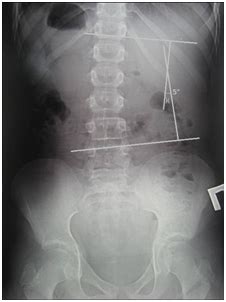 Spontaneous pneumothorax usually requires surgical resection. РЕНТГЕНОГРАФИЯ И КОМПЬЮТЕРНАЯ ОПТИЧЕСКАЯ ТОПОГРАФИЯ В ...