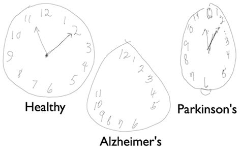 In a study, normal people scored an average of 27.4; Caneta Digital pode ajudar a diagnosticar Alzheimer - Pplware