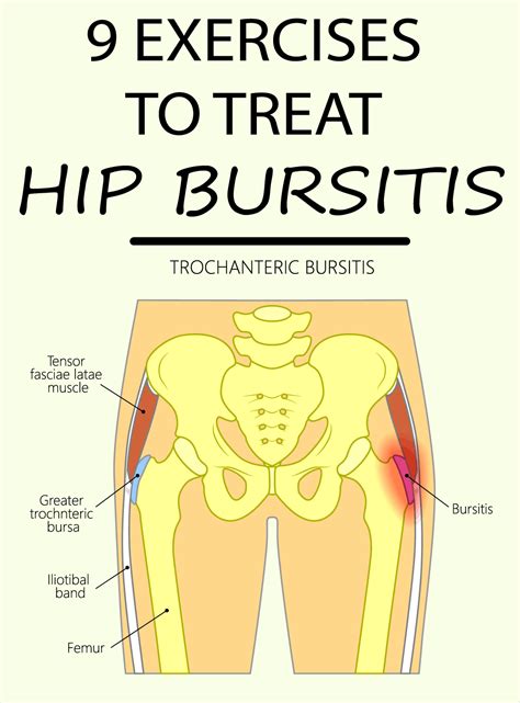 Hip bursitis can become especially challenging for runners. 9 EXERCISES TO TREAT HIP BURSITIS | Bursitis hip, Hip ...
