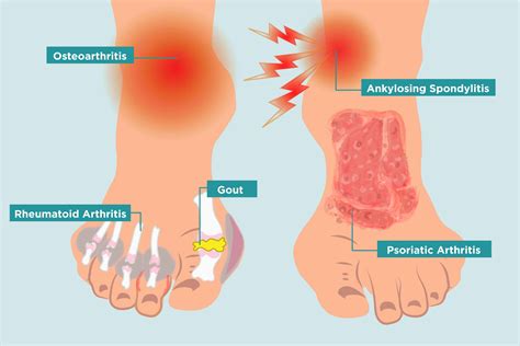 If can effect almost any part of the body but is mainly seen in the skin tissue. What are the diseases of psoriatic arthritis? Symptoms of ...