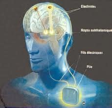 Depuis, d'autres indications neurologiques sont venues s'ajouter à la maladie de parkinson et aux tremblements essentiels : La stimulation cérébrale profonde : nouvelle arme contre l ...