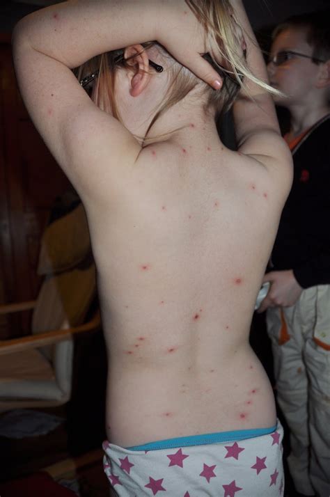 Chickenpox usually clears up within a couple of weeks. Chicken Pox in Babies Pictures - 11 Photos & Images ...
