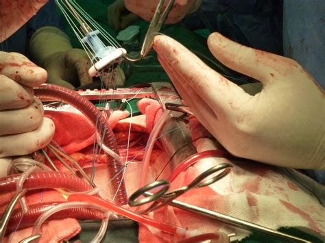 Open heart surgery (ventricular septal defect repair) live at the trauma centre, national hospital, abuja. Bintang Jatuh: open heart surgery