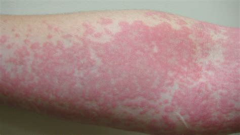Coronavirus: Skin rash can be only COVID-19 symptom and ...