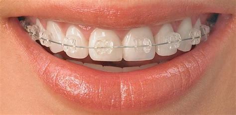 Once the alignment process is complete, a temporary retainer may be required until the teeth adjust to the new positioning. 7 Photos Teeth Alignment At Home And Review - Alqu Blog