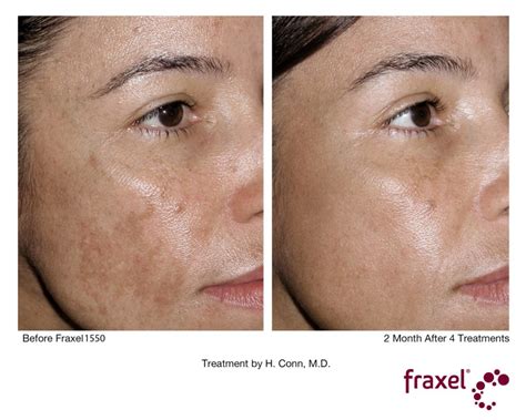 De la cruz, ointment, acne treatment with 10% sulfur, maximum strength,. Fraxel Hautverjüngung und Erneuerung - Mein natürliches Makeup